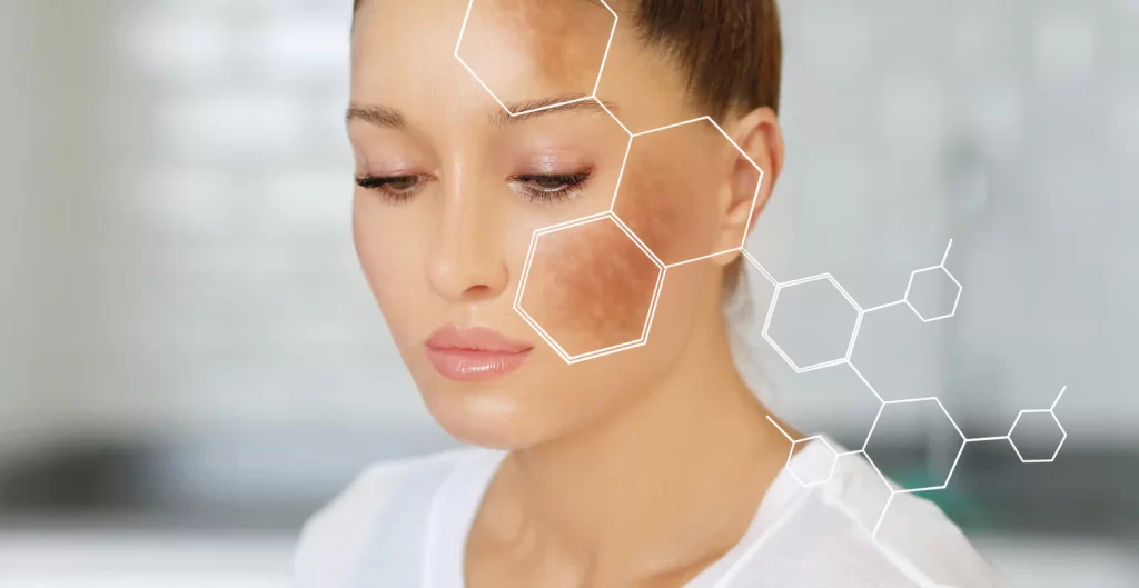 Hyperpigmentation Treatment: How to Achieve Even-Toned and Radiant Skin