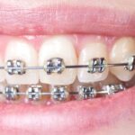 Choosing Between Braces and Invisalign