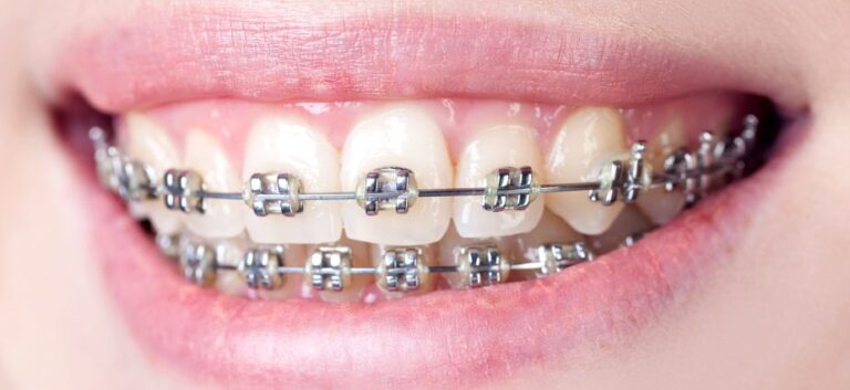 Choosing Between Braces and Invisalign