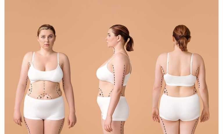 What to Expect from Liposuction Recovery in Newport Beach