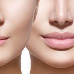 Lip Filler Types, Techniques, and Expected Results