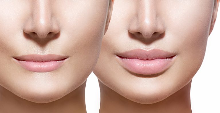 Lip Filler Types, Techniques, and Expected Results