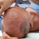 From Consultation to Results: Hair Transplant Journey in Dubai