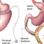 Common Reasons Patients Undergo Band to Sleeve Revision Surgery