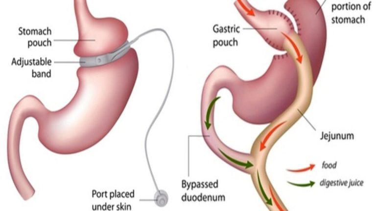 Common Reasons Patients Undergo Band to Sleeve Revision Surgery
