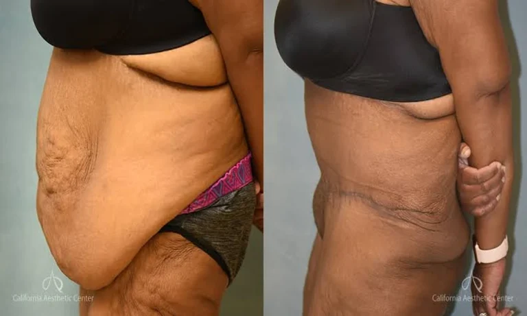 What to Expect Before, During and After Panniculectomy Surgery