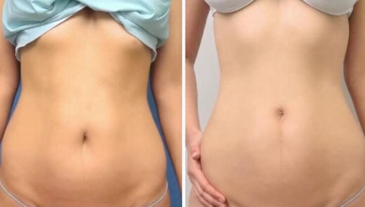What to Expect Before, During and After Panniculectomy Surgery