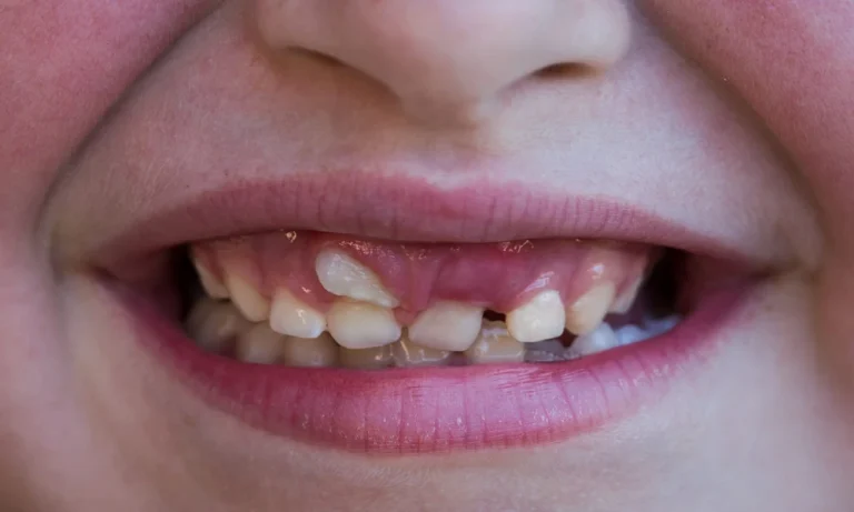 What Happens When A Child’s Permanent Tooth Erupts With An Unusual Shape