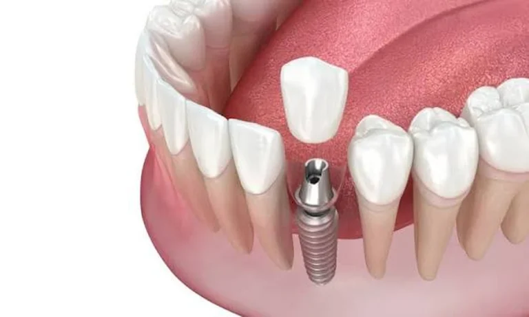 Laser Teeth Whitening in Turkey: Cost, Treatment Abroad