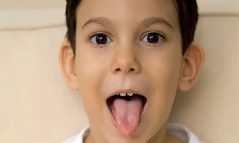 Geographic Tongue In Children: What A Pediatric Dental Evaluation Can Clarify